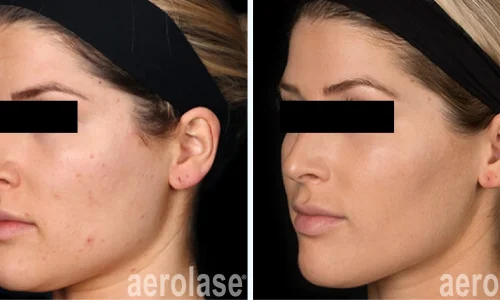 a woman with a black headband and acne | before and after photo | Meraki Wellness & Med Spa | Altamonte Springs, FL