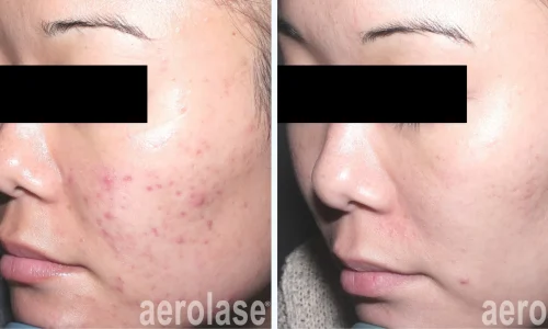 a woman's face with acne on cheeks | before and after photo | Meraki Wellness & Med Spa | Altamonte Springs, FL