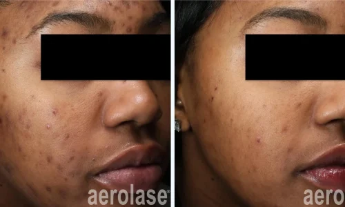 a woman's face with acne removal | before and after photo | Meraki Wellness & Med Spa | Altamonte Springs, FL