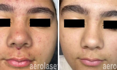 Acne treatment | before and after photo | Meraki Wellness & Med Spa | Altamonte Springs, FL