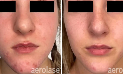 a woman's face with acne on cheeks and chin | before and after photo | Meraki Wellness & Med Spa | Altamonte Springs, FL