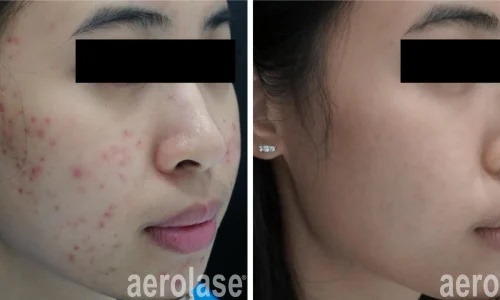 a woman's face with acne | before and after photo | Meraki Wellness & Med Spa | Altamonte Springs, FL