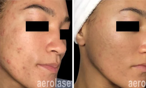 a close up of a person's face | before and after photo | Meraki Wellness & Med Spa | Altamonte Springs, FL