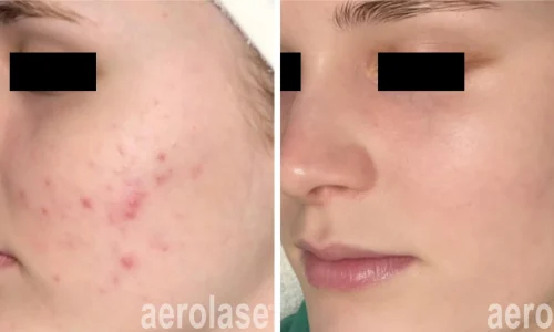 a close up of a girl's acne face | before and after photo | Meraki Wellness & Med Spa | Altamonte Springs, FL