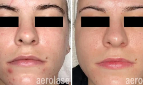 a woman's face before and after acne procedure | Meraki Wellness & Med Spa | Altamonte Springs, FL