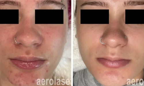 a woman with a nose ring and acne before and after photo | Meraki Wellness & Med Spa | Altamonte Springs, FL