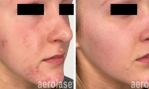 a close up of a woman's face with acne | before and after photo | Meraki Wellness & Med Spa | Altamonte Springs, FL