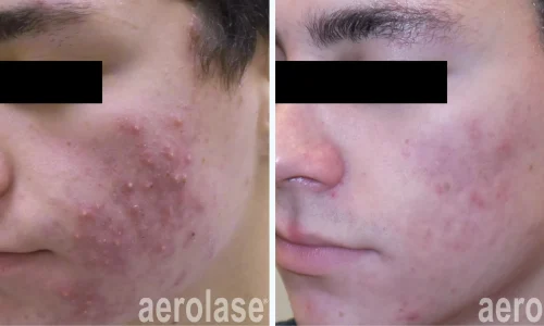 Cystic acne on face | before and after photo | Meraki Wellness & Med Spa | Altamonte Springs, FL