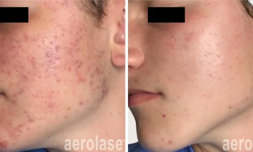 a person with acne on their face | before and after photo | Meraki Wellness & Med Spa | Altamonte Springs, FL