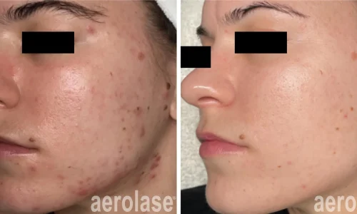 Acne | before and after photo | Meraki Wellness & Med Spa | Altamonte Springs, FL