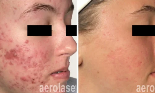 Acne on girl's side face | before and after photo | Meraki Wellness & Med Spa | Altamonte Springs, FL