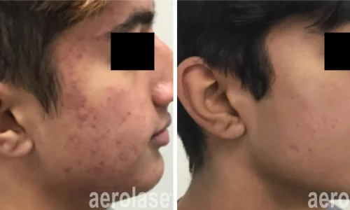 Acne on side face | before and after photo | Meraki Wellness & Med Spa | Altamonte Springs, FL