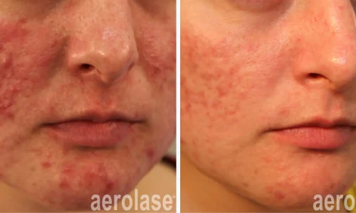 Excessive acne removal | before and after photo | Meraki Wellness & Med Spa | Altamonte Springs, FL