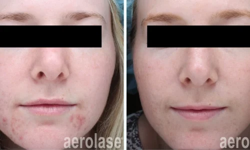 Acne on girl's face | before and after photo | Meraki Wellness & Med Spa | Altamonte Springs, FL