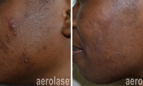 Acne before and after photo | Meraki Wellness & Med Spa | Altamonte Springs, FL