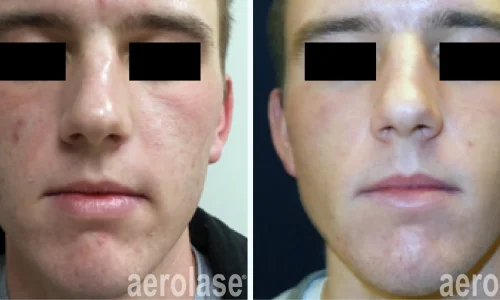 Acne removal treatment | before and after photo | Meraki Wellness & Med Spa | Altamonte Springs, FL