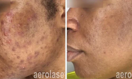 Cystic acne on man's face | before and after photo | Meraki Wellness & Med Spa | Altamonte Springs, FL