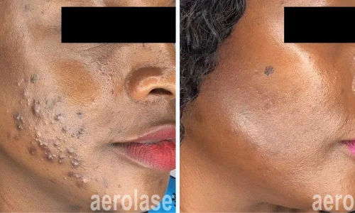 big acne | before and after photo | Meraki Wellness & Med Spa | Altamonte Springs, FL