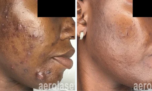 a close-up of a stubborn acne on face | before and after photo | Meraki Wellness & Med Spa | Altamonte Springs, FL