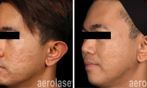 Acne and scars | before and after photo | Meraki Wellness & Med Spa | Altamonte Springs, FL