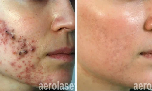 Stubborn acne | before and after photo | Meraki Wellness & Med Spa | Altamonte Springs, FL