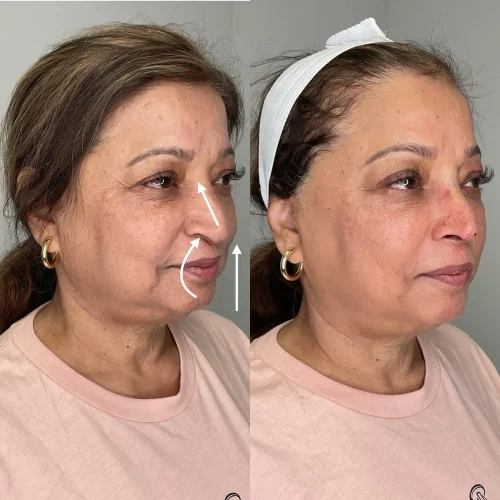 Non-Surgical Nosejob (1)