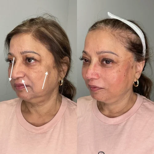 Non-Surgical Nosejob