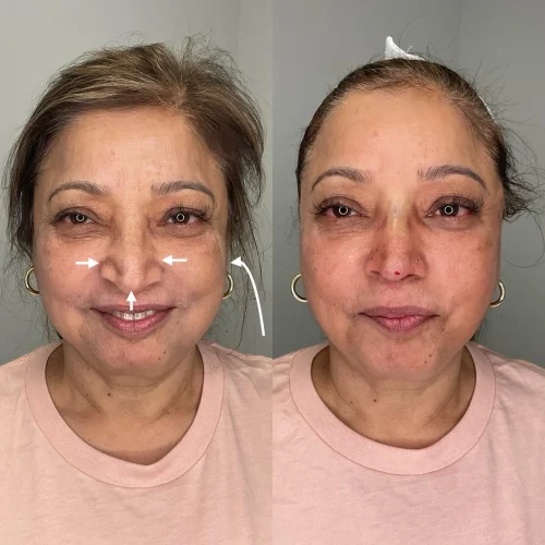 Nonsurgical Nosejob