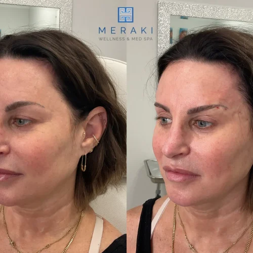 Silhouette Threads + Eyebrow Lift