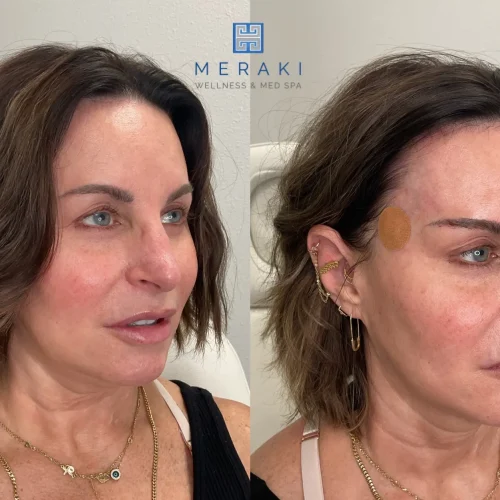 Silhouette Threads + Eyebrow Lift